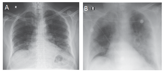Hasil X-ray pada dada pasien yang terinfeksi MERS-CoV di Arab Saudi