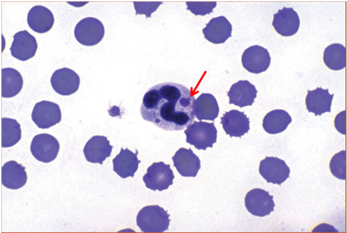 Pemeriksaan mikroskopis (preparat ulas darah) pada darah anjing yang terinfeksi Canine Distemper Virus ditemukan adanya badan inklusi di dalam sitoplasma netrofil (panah)