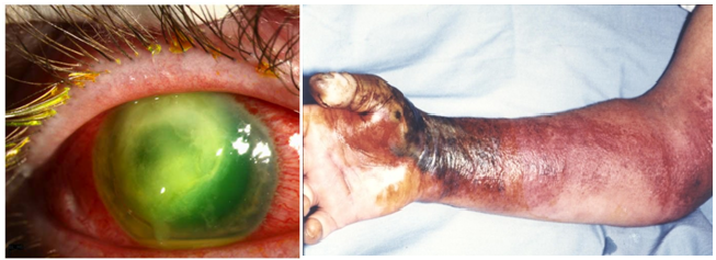 infeksi oleh Pseudomonas aeruginosa
